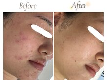 ミラリー(MIRALY)/敏感ニキビ肌ケア5ヶ月(20代)