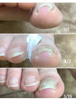 リゼラアンドコー 布施店/巻き爪ケア途中経過