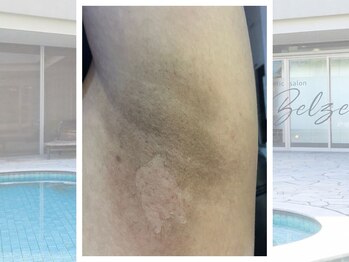 ベルゼ 渋谷店(BELZE)/最先端黒ずみケア！