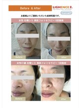 マル(MARU)/光フェイシャル