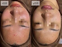 ヒナノ 矢場町店(HINANO)/FCRトリートメント