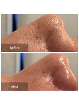 リジュベ(Rejuve)/毛穴エクストラクション[本八幡]