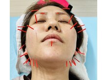 そら鍼灸整骨院/★大人気な美容鍼★