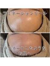 ゆでたまご/次世代ピーリング