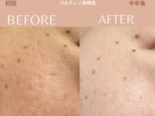 パルティノ 高崎店の雰囲気（毛穴の黒ずみ・毛穴洗浄・エクソソームでくすみ・お悩み解決へ）