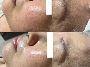 ミルジュ(MiLuJu)/タラソ　Before& After