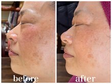 ルー ハナレ 神戸岡本 摂津本山店(Luu HANARE)/小顔シミ・シワ・たるみ改善