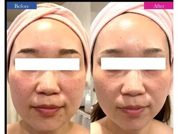 マールム(MALUM)/CMフェイシャル　before/after