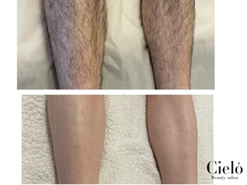 シエロ 赤坂店(Cielo)の写真/多くの男性からも支持☆＜シュガーリング＞面倒な毎日の自己処理からはもう卒業★清潔感のあるモテ肌へ
