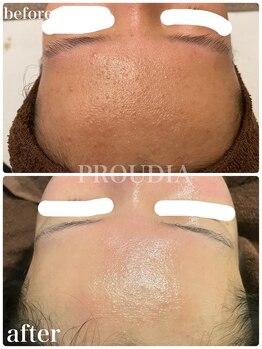 プラウディア(PROUDIA)/ハーブピーリング/肌荒れ/毛穴