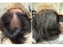 セントラル鍼灸院リラクシー(Re:laxy)/1年半でもまた変化で今は月1に