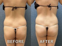 ビーホープ(B.hope)/30代産後モニター様2回目