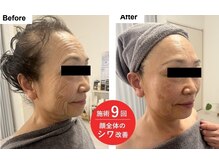 トリアングル(TLIENGLE)/最新エレクトロボレーション