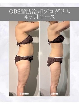 OBSの写真/本気で痩せたい方に向けた無料の３０分カウンセリングも受付中！脂肪冷却プログラム検討中の方は必見♪