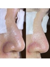 アデュラリアン(Adularian)/毛穴エクストラクション