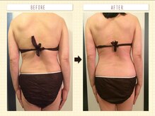 ハピア(HappiA)/ボディ痩身 キャビテーション