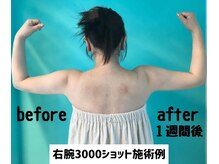 エルモーサ(HERMOSA)/二の腕たるみが気になる方に！