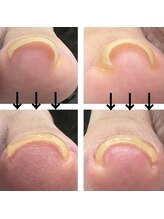 ジーニー(Genie)/巻き爪ケア &nbsp;1回での変化