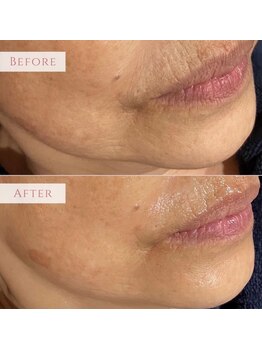 アンドニューリー(&NEWLY)/LDM水玉リフティング