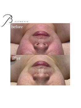 ビー エステティック(B ESTETIC)/結果重視！美肌菌PLUS