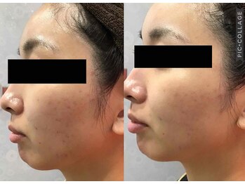 チャマ 高知店(CHAMA)/剥離しないハーブピーリング☆