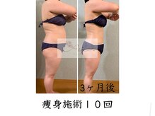アイ エステサロン(Ai)/【２０代後半】ダイエット途中