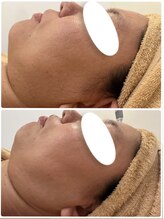 エヌ(enu)/ハーブピーリング/フェイシャル