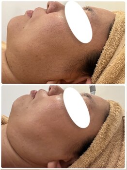 エヌ(enu)/ハーブピーリング/フェイシャル