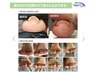 巻き爪ケア親指２本+ specialフットケア　10500円→8500円