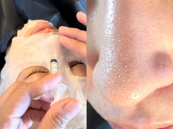 i'm este 新宿店【肌管理×小顔/毛穴改善フェイシャルサロン】-小顔/毛穴/シミケア-の写真/え!?これ私の肌から出たの?高濃度水素×吸引でごっそり角栓OFFし黒ずみレス肌。話題の最先端毛穴洗浄専門店