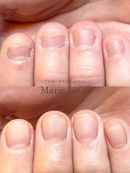 マリーロール 梅田店(Marie Laure)/自爪育成/深爪矯正/ネイルケア
