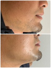 グラン(GRAN)/メンズヒゲ脱毛