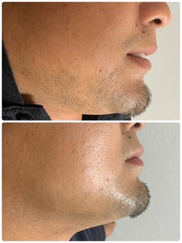 グラン(GRAN)/メンズヒゲ脱毛