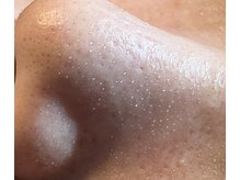 フェアリー(Fairy)/【ハイドラ水素ピーリング】