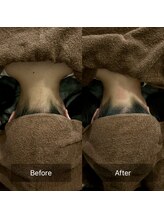 セメ(S’aimer)/うなじ脱毛(Mパーツ)2500円