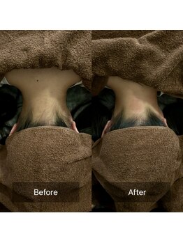 セメ(S’aimer)/うなじ脱毛(Mパーツ)2500円