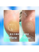 巻き爪補正店 秋葉原店/【硬いタコ/魚の目ケア】