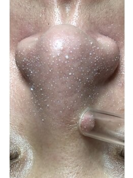 メディカルエステ ユウ(Yuu)の写真/人気沸騰◎韓国肌管理「ララピール」「韓国式３D毛穴洗浄」で韓流肌に♪白くキメの細かい毛穴レス美肌を
