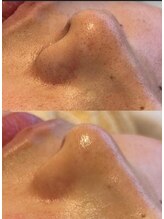 美容整骨小顔ラボ/鼻の毛穴改善ビフォーアフター