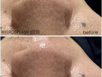 アンリミット 鹿児島天文館店(Une limit)/頑固な毛穴も毛穴レスに！