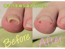 ニコルル 大阪天満店(Nicolulu)/巻き爪は、酷くなる前に！