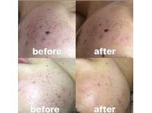 ビューティーネイル(Beauty Nail)/毛穴エクストラクション