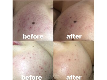 ビューティーネイル(Beauty Nail)/毛穴エクストラクション