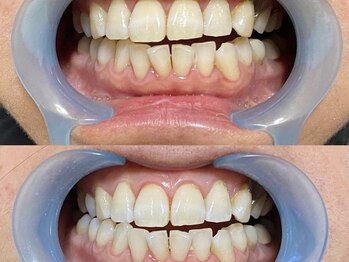 アーティ(aaty)/セルフホワイトニング/白い歯