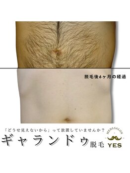 イエス 東京池袋店(YES)/お腹脱毛