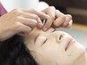 初回限定割引【美容鍼+頭痛改善+眼精疲労】美容+頭皮鍼でスッキリ¥6500→4500