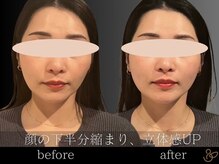 チョコバリ 郡山店(chocobari)/小顔×リフトアップ(美容鍼)20代