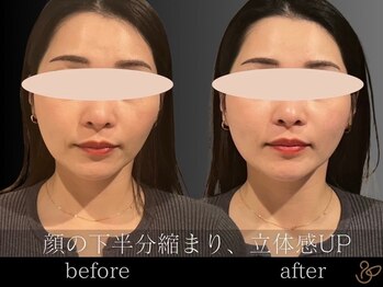 チョコバリ 郡山店(chocobari)/小顔×リフトアップ(美容鍼)20代