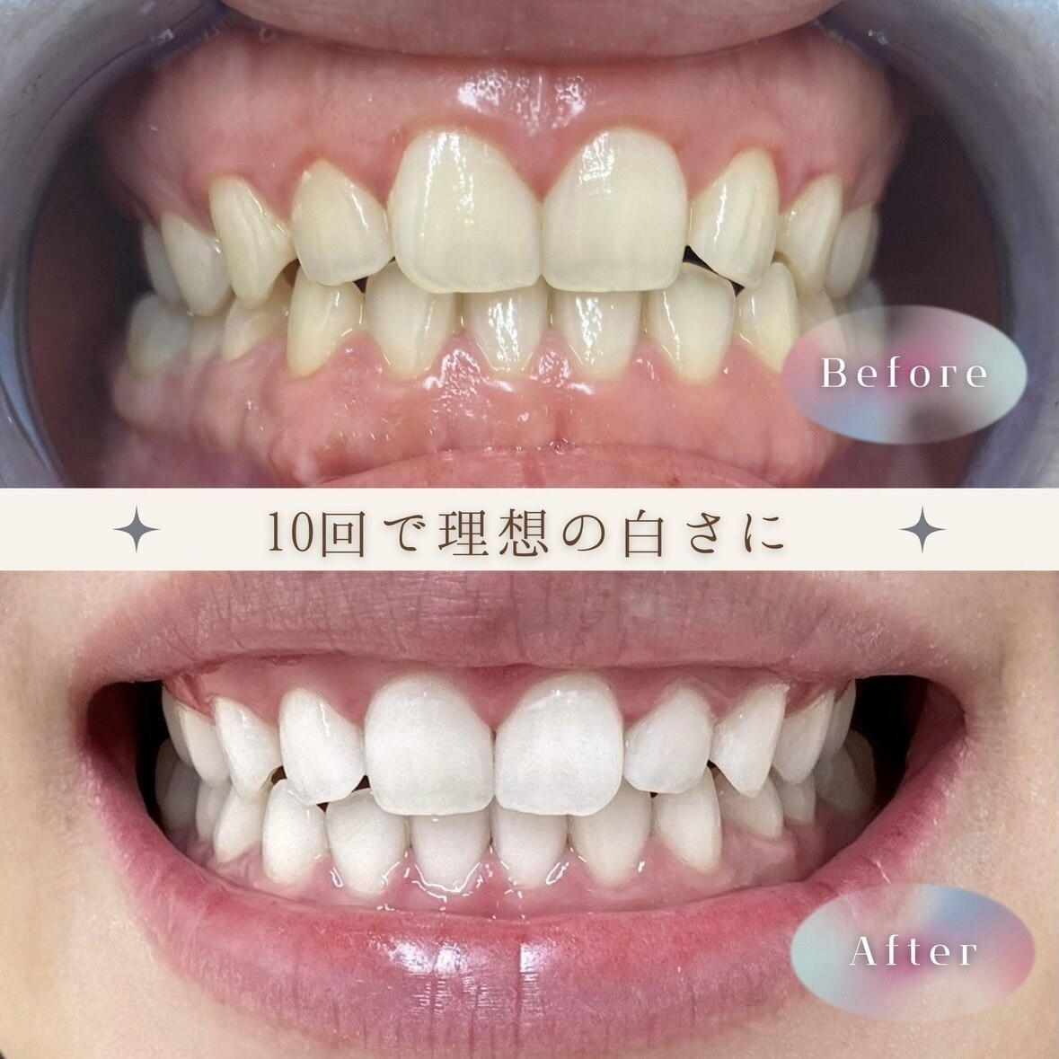 確認ホワイトニング ホワイトニングショップ 徳島藍住店｜ホットペッパービューティー