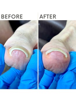 クオッカ(Quokka)/巻き爪ケア